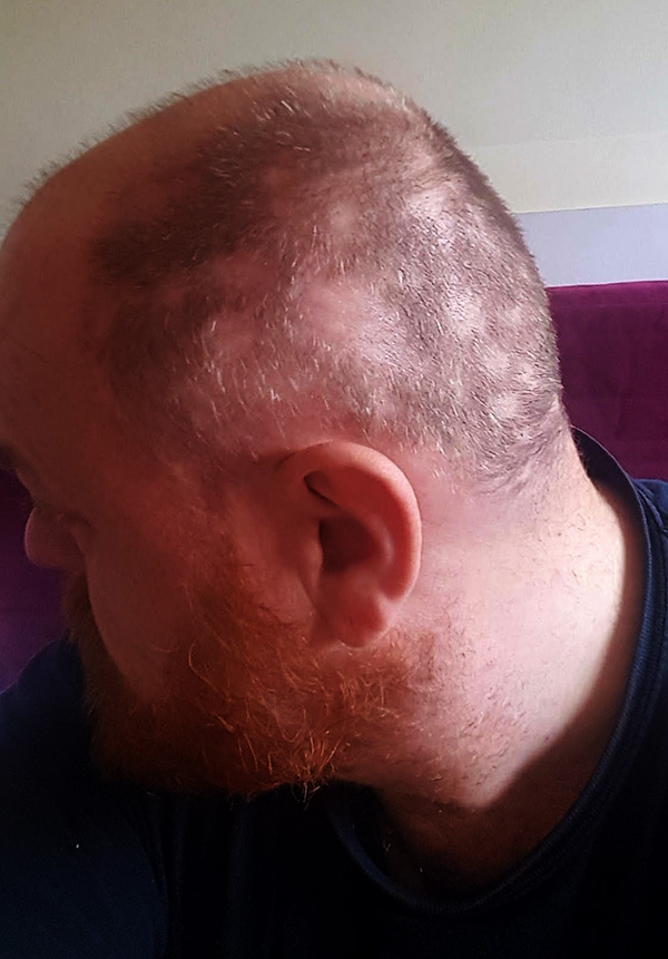 May Update - Hair Loss (1)